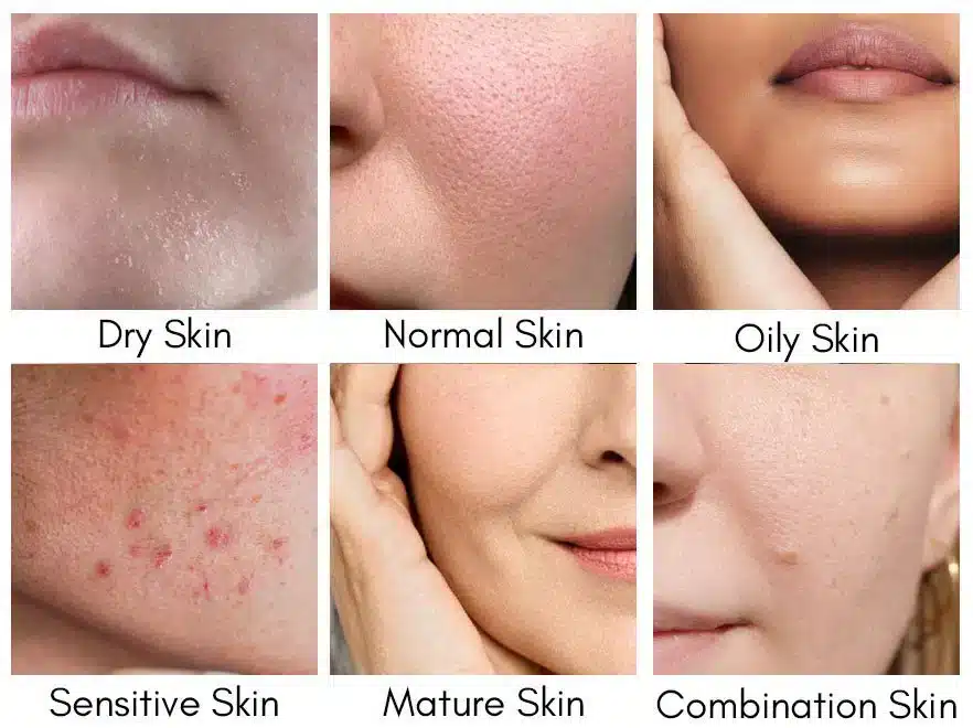 different skin types mentioned in one picture